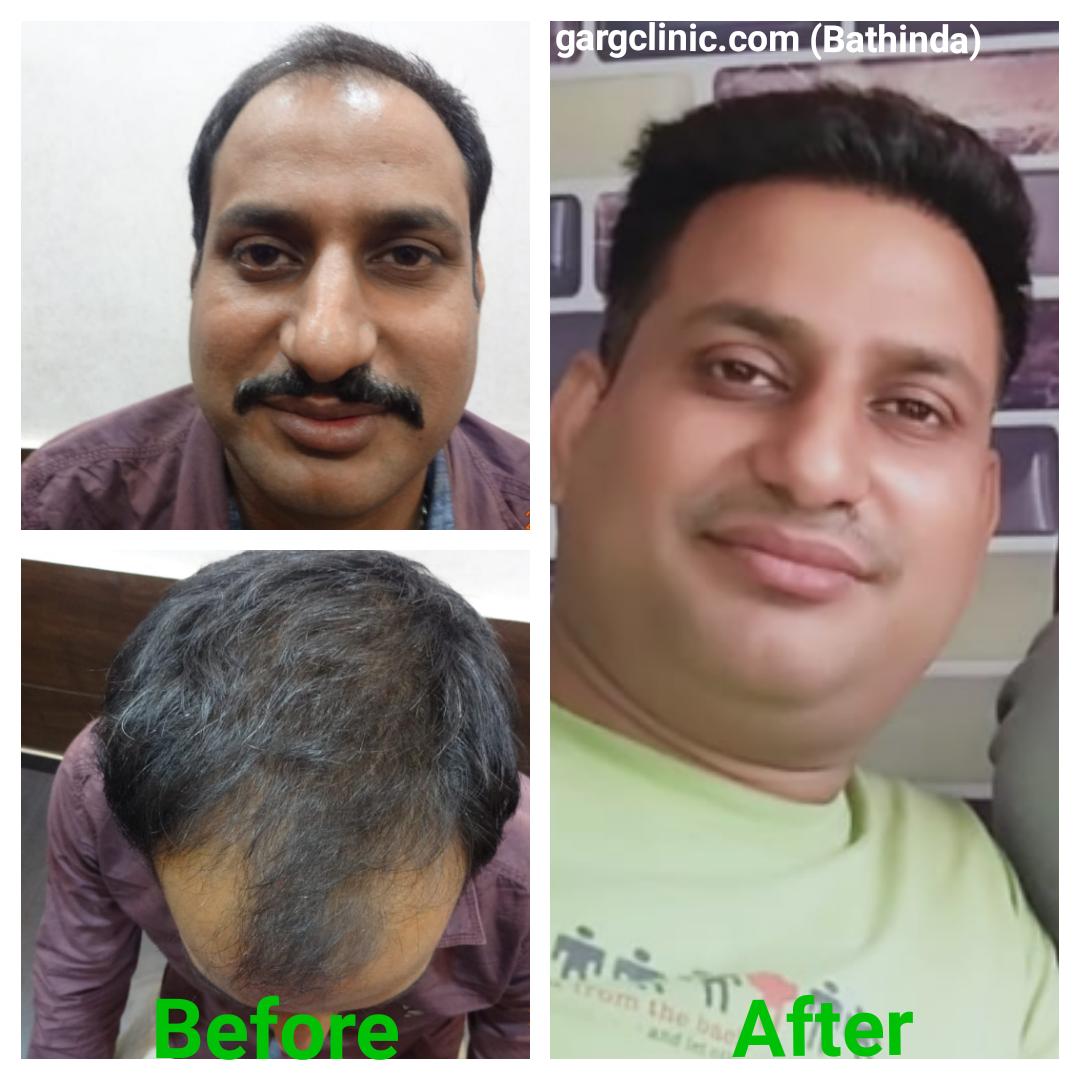 Garg Hair Transplant Clinic