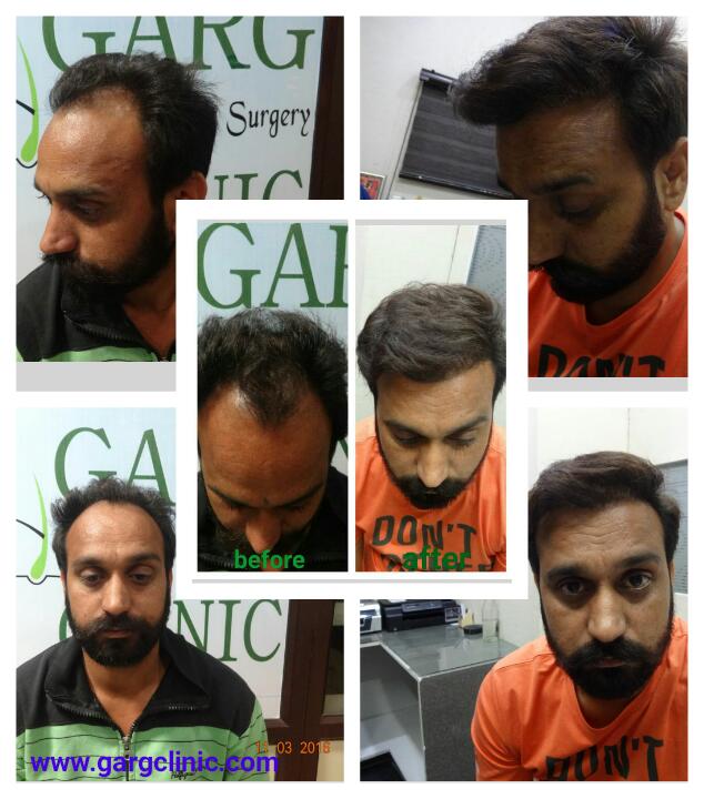 Garg Hair Transplant Clinic