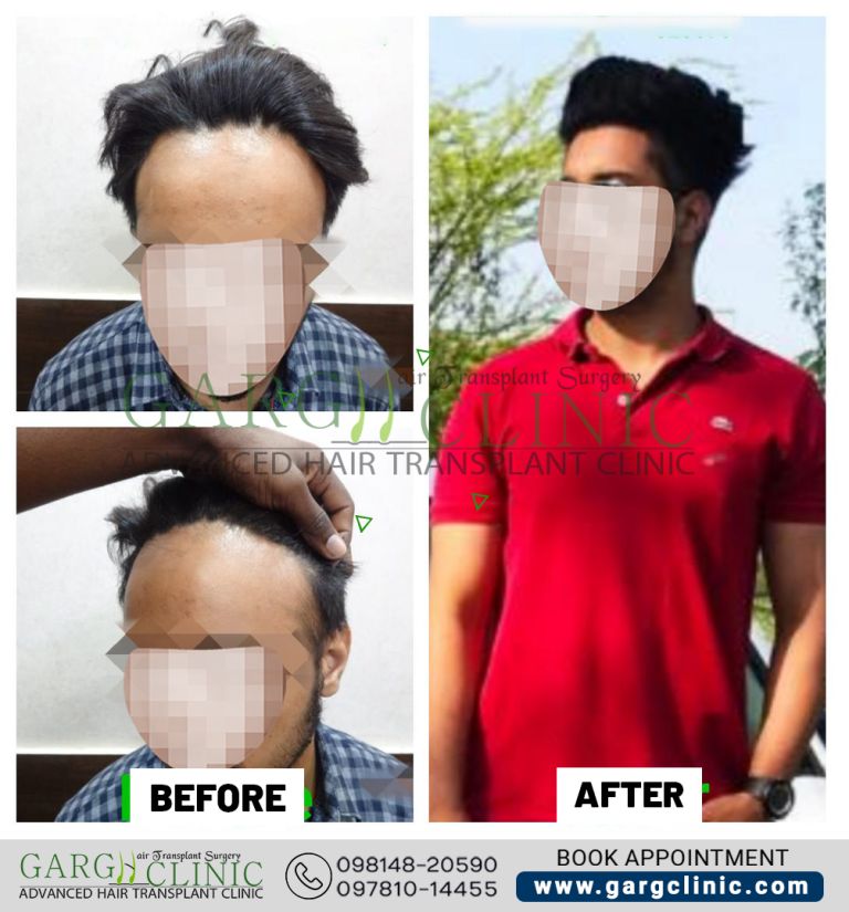 Garg Hair Transplant Clinic