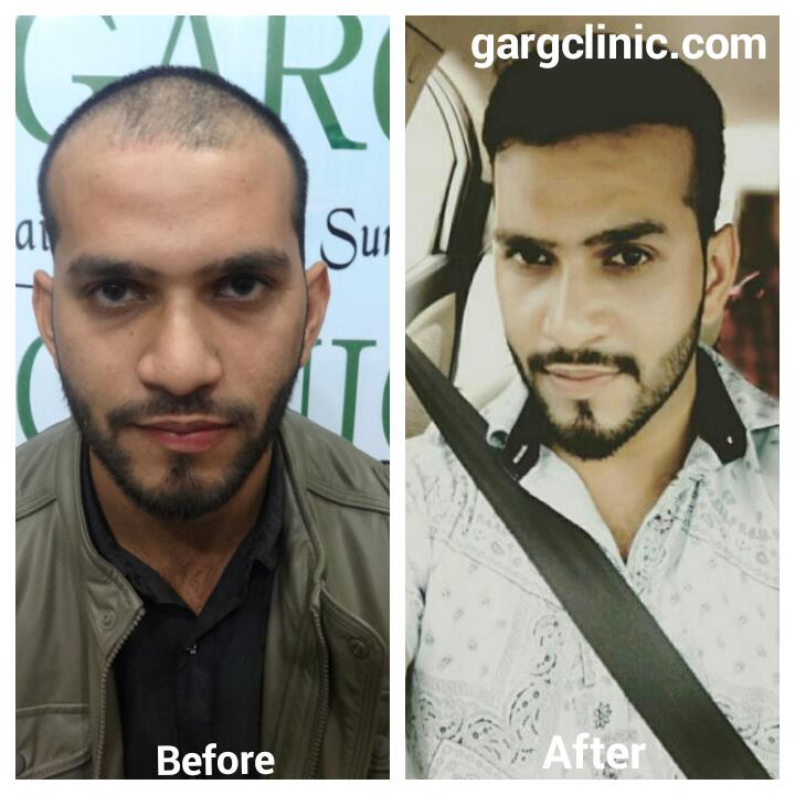 Garg Hair Transplant Clinic