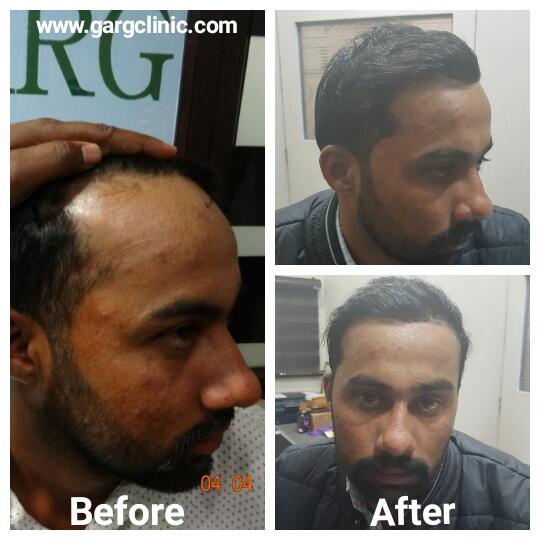 Garg Hair Transplant Clinic