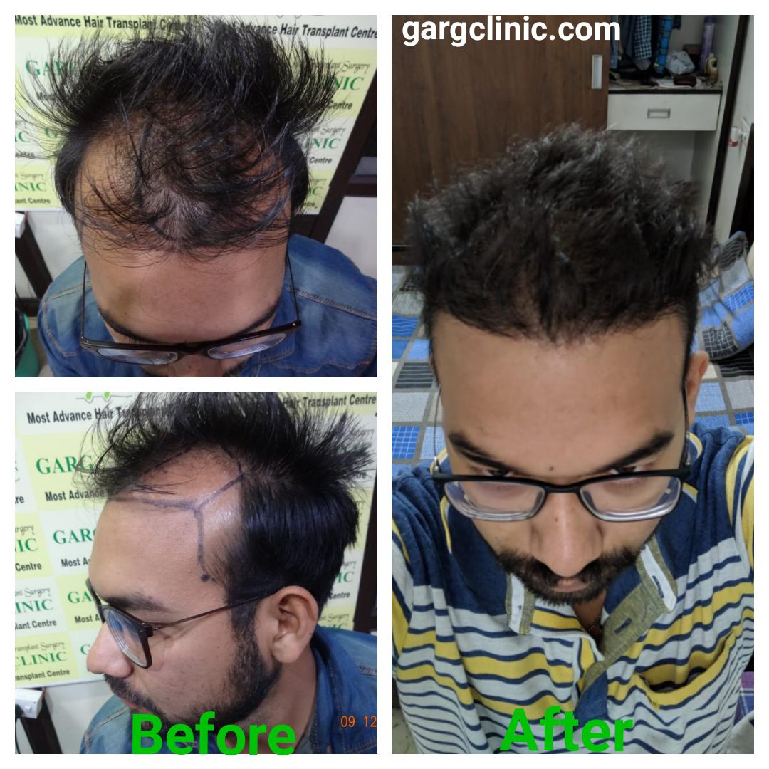 Garg Hair Transplant Clinic
