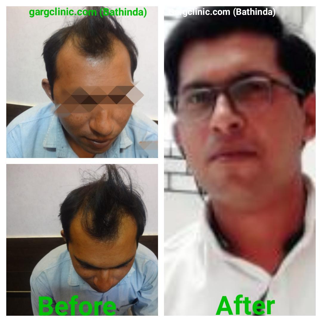 Garg Hair Transplant Clinic