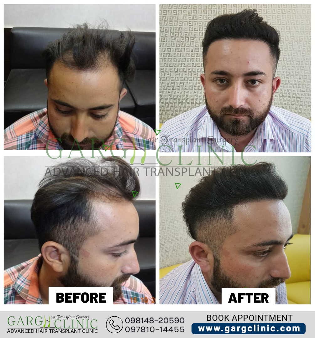 Garg Hair Transplant Clinic