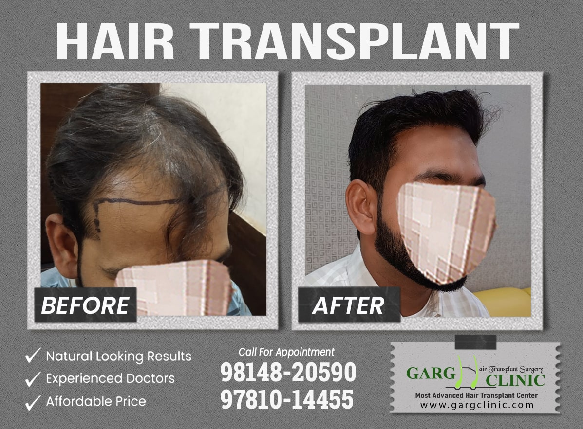 Garg Hair Transplant Clinic