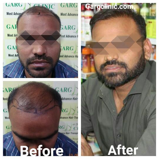 Garg Hair Transplant Clinic