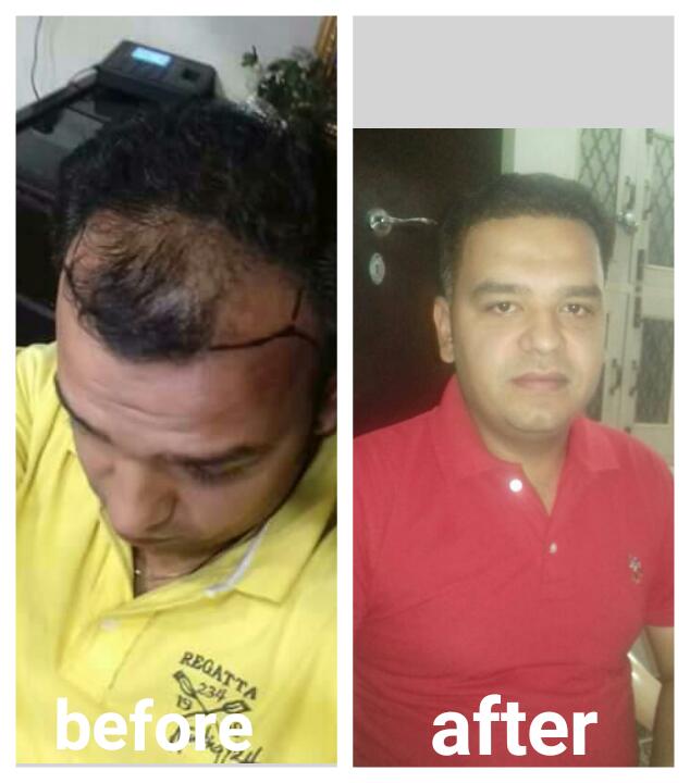 Garg Hair Transplant Clinic