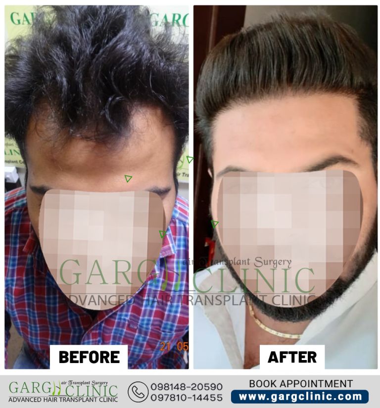 Garg Hair Transplant Clinic