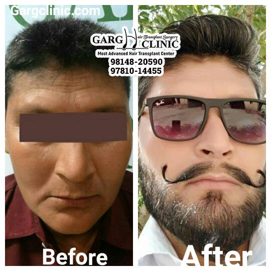 Garg Hair Transplant Clinic