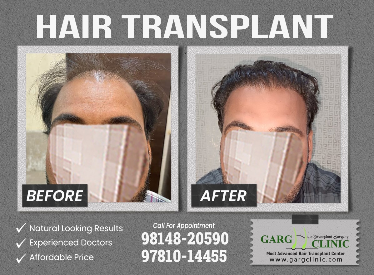 Garg Hair Transplant Clinic