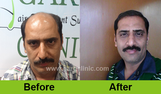 Garg Hair Transplant Clinic