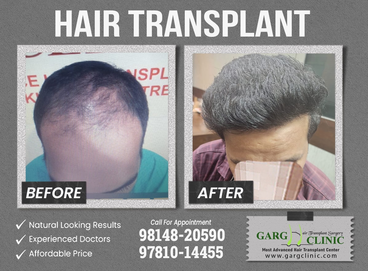 Garg Hair Transplant Clinic