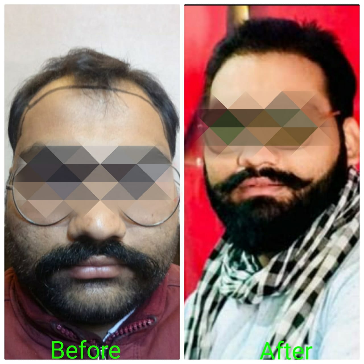Garg Hair Transplant Clinic
