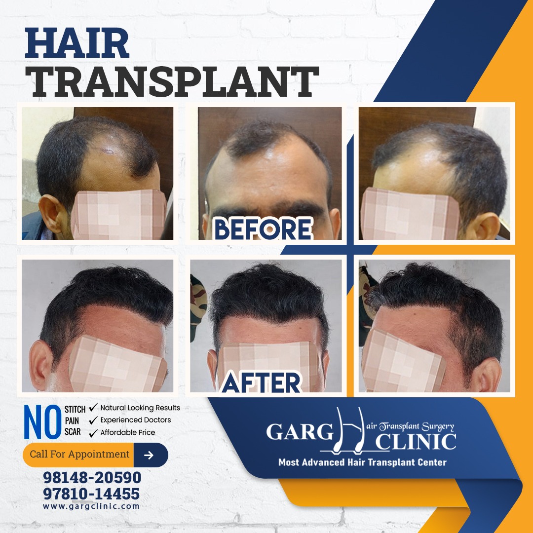 Garg Hair Transplant Clinic