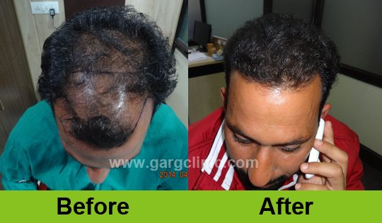 Garg Hair Transplant Clinic