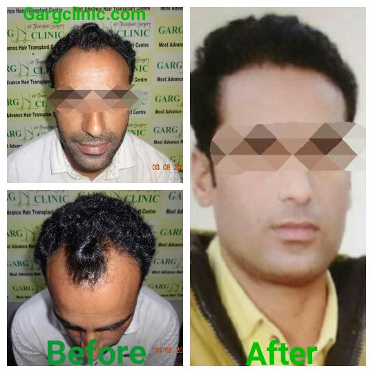 Garg Hair Transplant Clinic