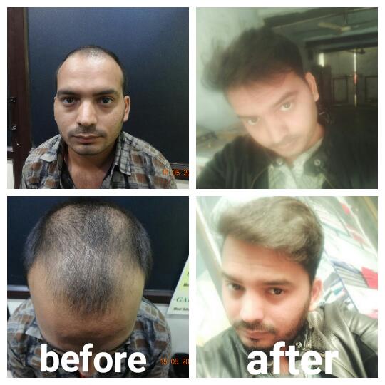 Garg Hair Transplant Clinic