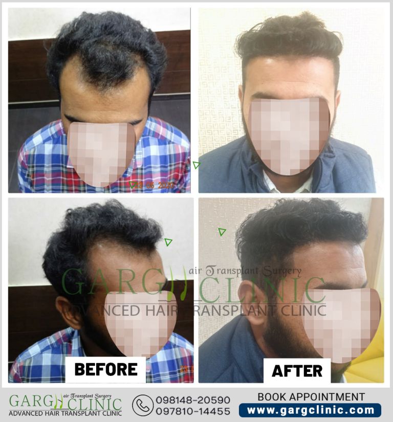 Garg Hair Transplant Clinic