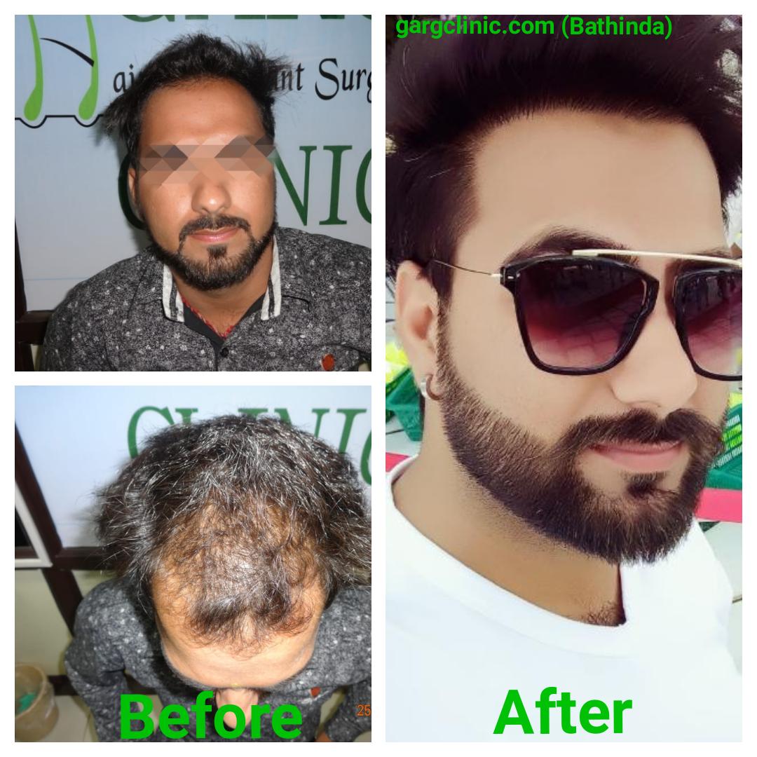 Garg Hair Transplant Clinic