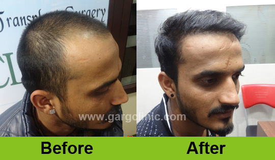 Garg Hair Transplant Clinic