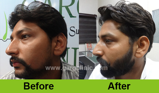 Garg Hair Transplant Clinic
