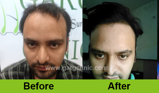 Garg Hair Transplant Clinic