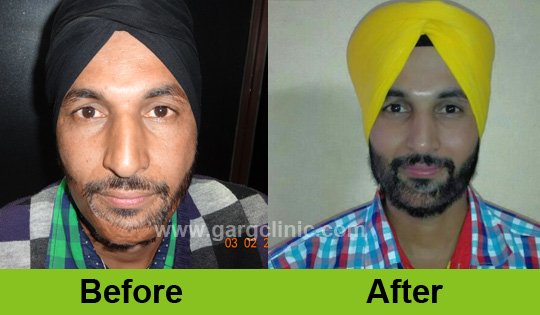 Garg Hair Transplant Clinic