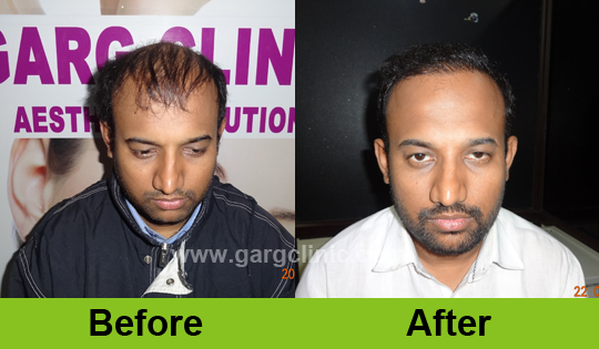 Garg Hair Transplant Clinic