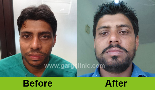 Garg Hair Transplant Clinic