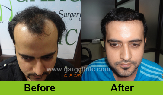 Garg Hair Transplant Clinic