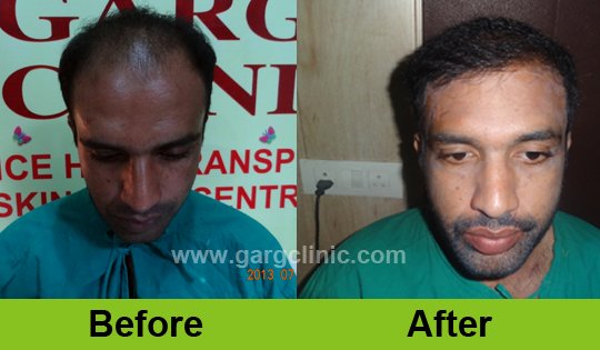 Garg Hair Transplant Clinic