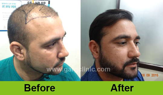 Garg Hair Transplant Clinic