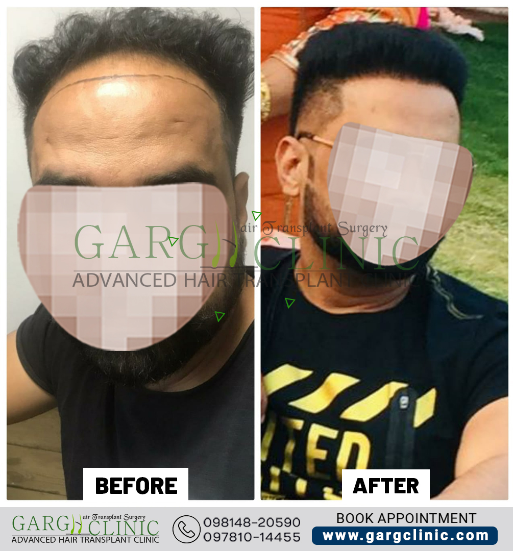 Garg Hair Transplant Clinic
