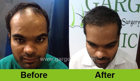 Garg Hair Transplant Clinic