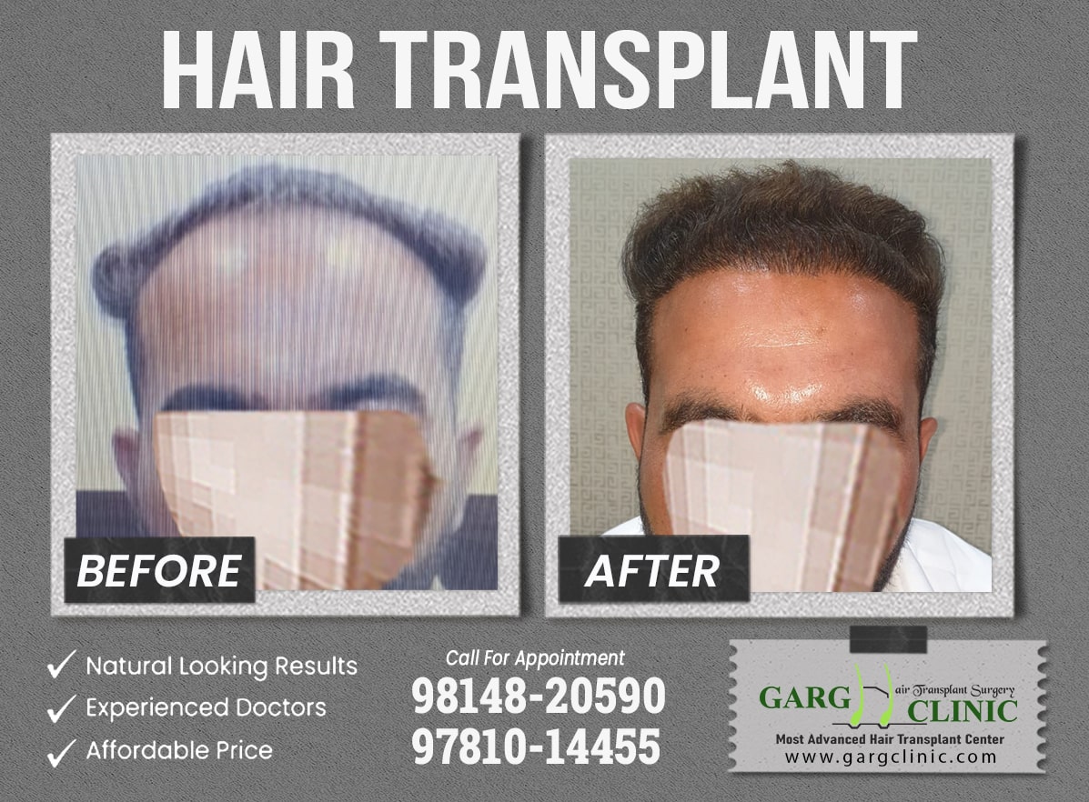 Garg Hair Transplant Clinic