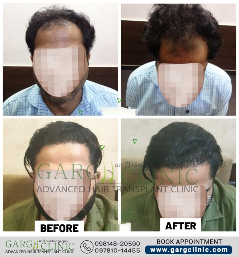 Garg Hair Transplant Clinic