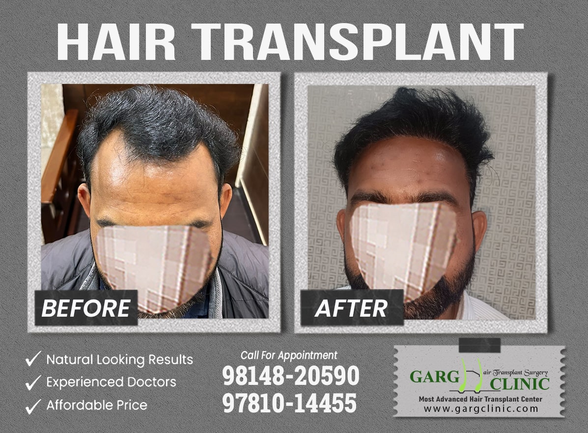 Garg Hair Transplant Clinic