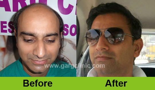 Garg Hair Transplant Clinic