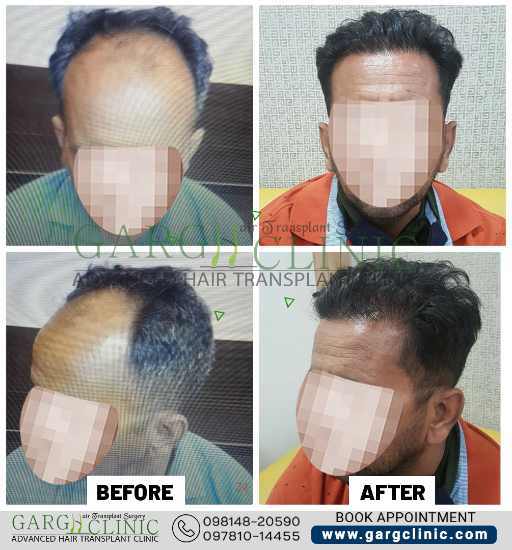 Garg Hair Transplant Clinic