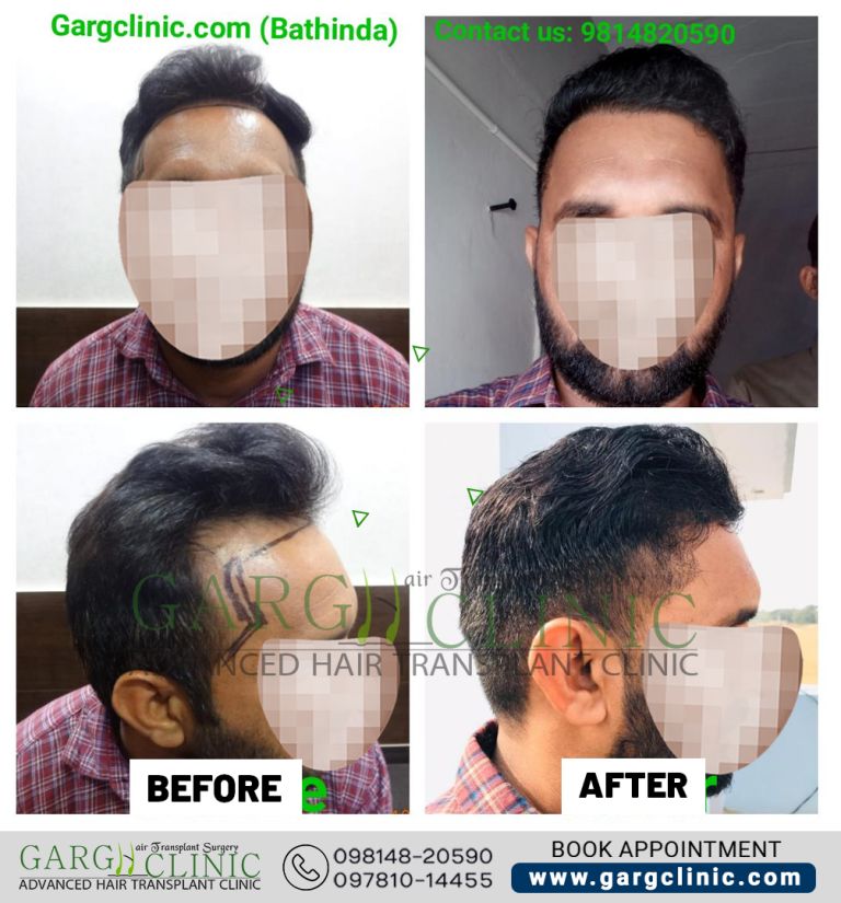 Garg Hair Transplant Clinic
