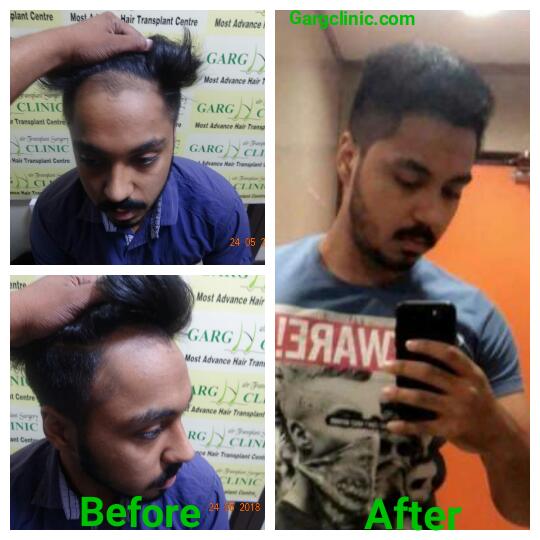 Garg Hair Transplant Clinic