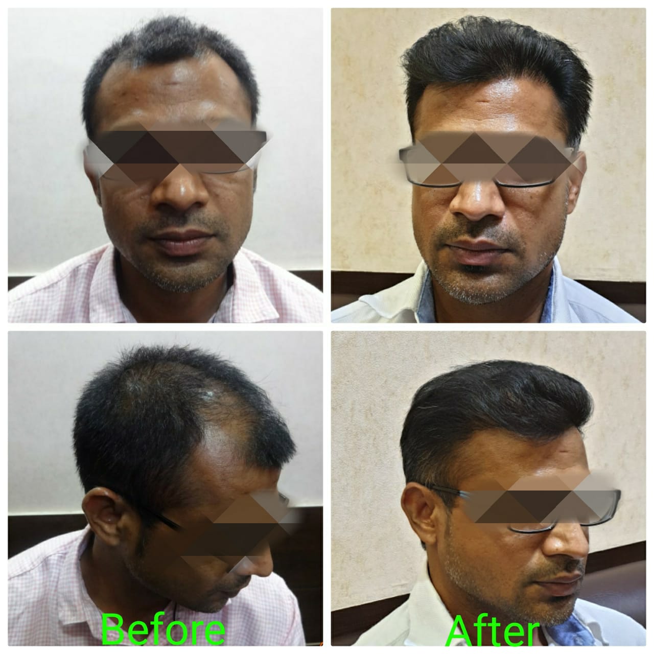 Garg Hair Transplant Clinic