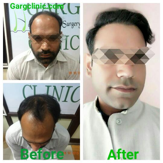 Garg Hair Transplant Clinic