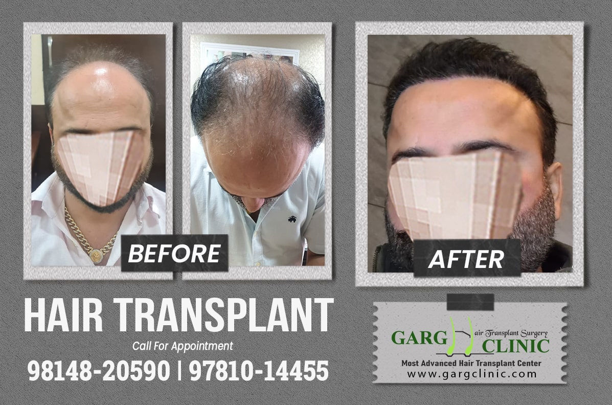 Garg Hair Transplant Clinic