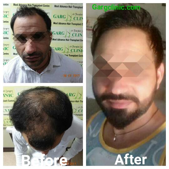 Garg Hair Transplant Clinic