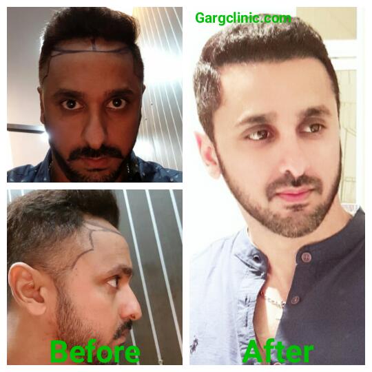 Garg Hair Transplant Clinic