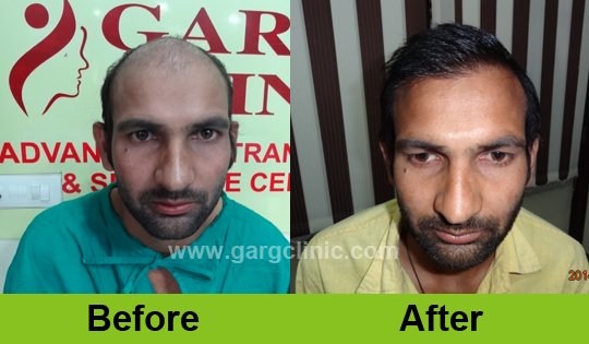 Garg Hair Transplant Clinic