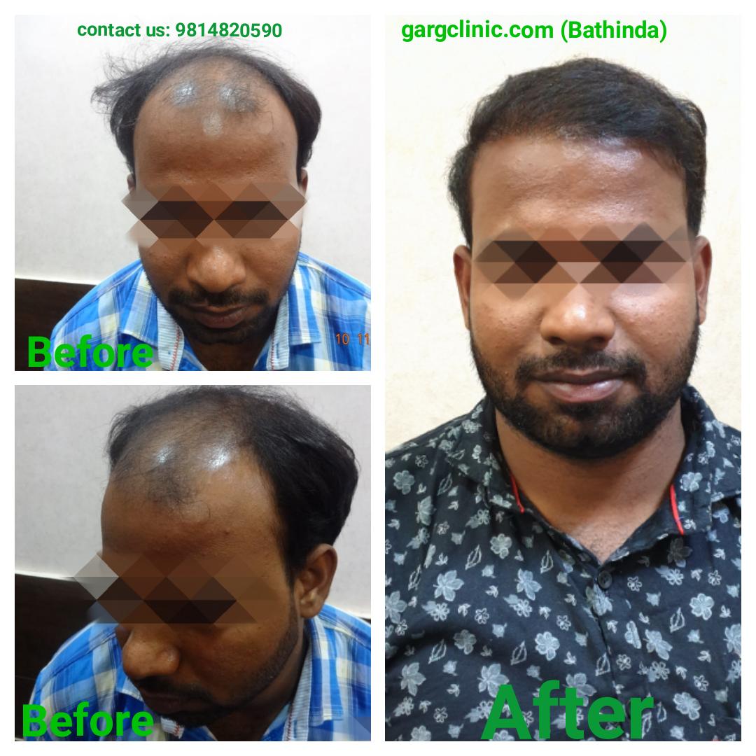 Garg Hair Transplant Clinic
