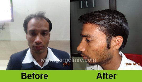 Garg Hair Transplant Clinic