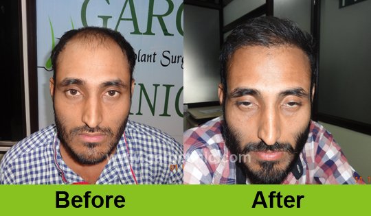 Garg Hair Transplant Clinic